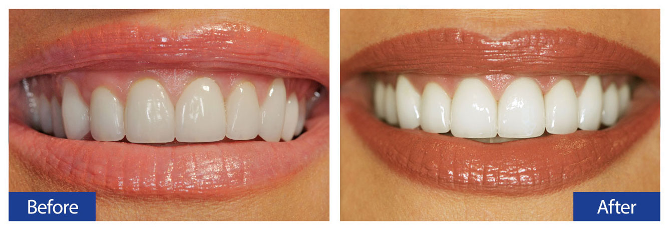 Before and After Teeth 15 Damon R. Johnson DDS Dental Excellence Edmond, OK