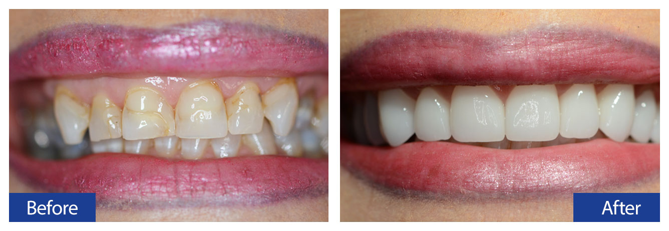 Before and After Teeth 7 Damon R. Johnson DDS Dental Excellence Edmond, OK