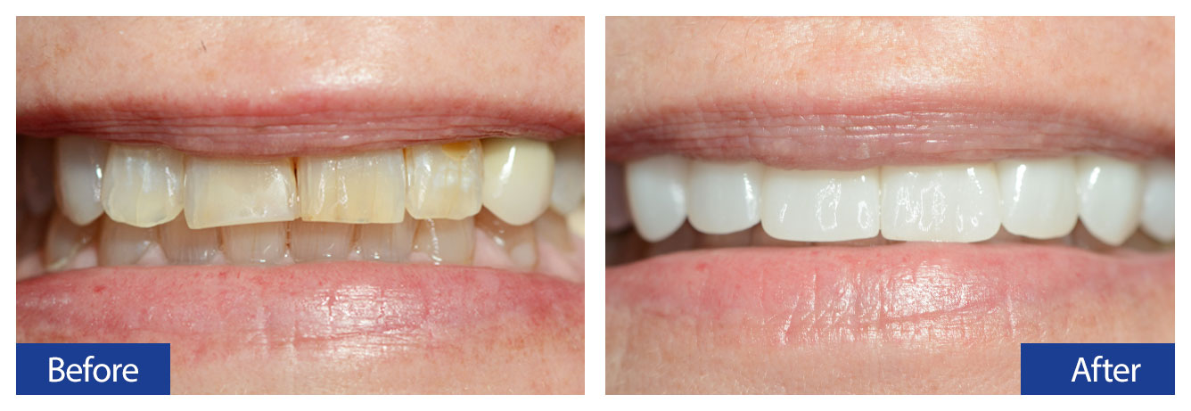Before and After Teeth 6 Damon R. Johnson DDS Dental Excellence Edmond, OK