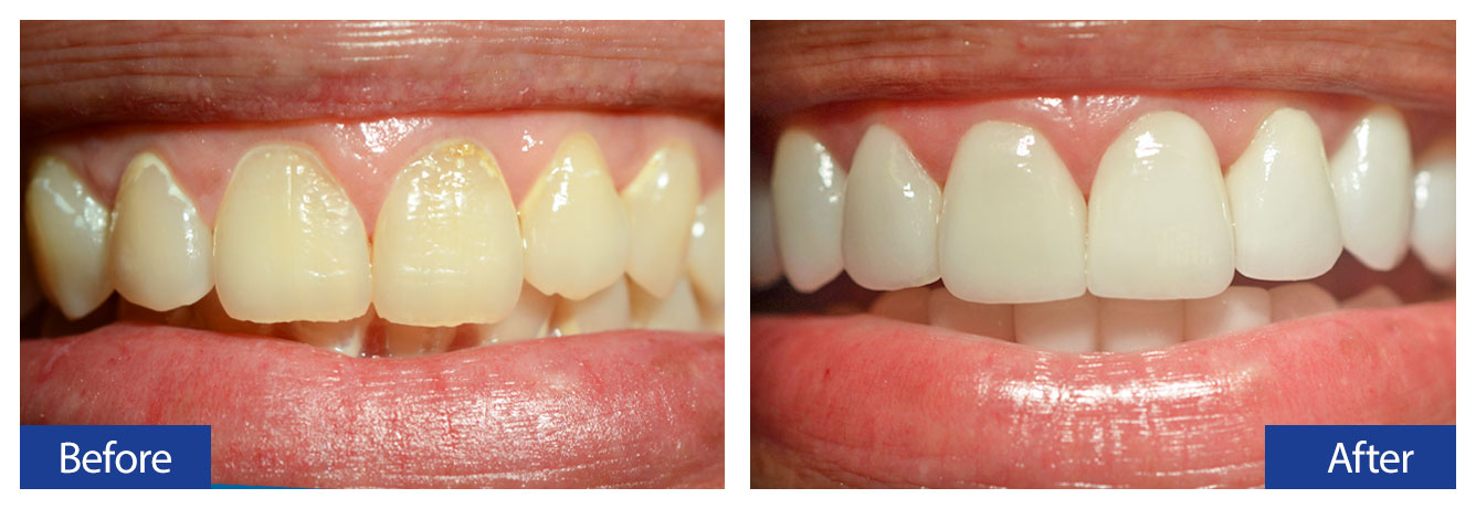 Before and After Teeth 4 Damon R. Johnson DDS Dental Excellence Edmond, OK