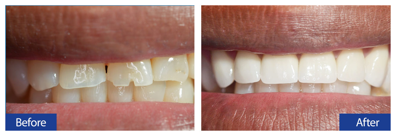 Before and After Teeth 3 Damon R. Johnson DDS Dental Excellence Edmond, OK