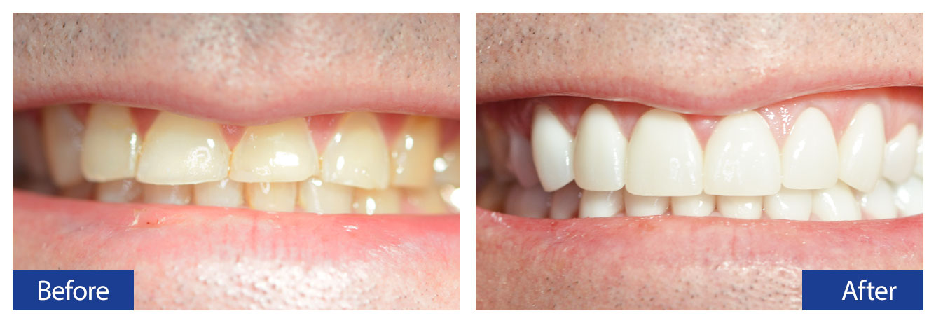 Before and After Teeth 2 Damon R. Johnson DDS Dental Excellence Edmond, OK
