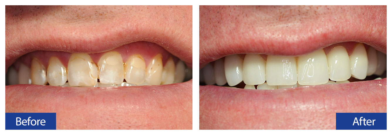Before and After Teeth 1 Damon R. Johnson DDS Dental Excellence Edmond, OK