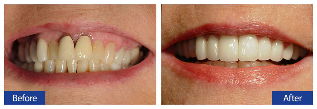 Before and After Teeth 14 Damon R. Johnson DDS Dental Excellence Edmond, OK
