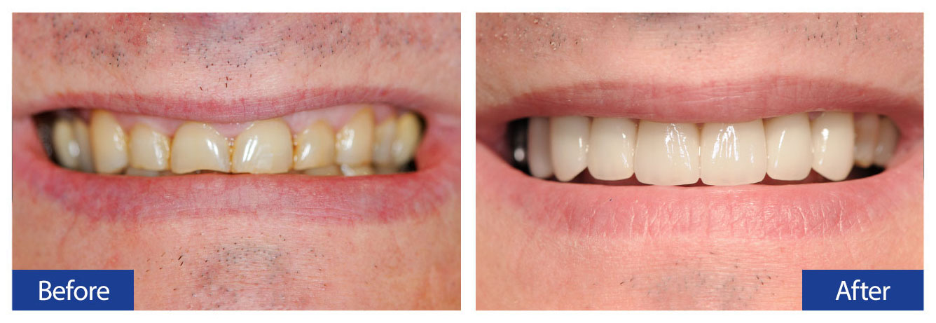 Before and After Teeth 12 Damon R. Johnson DDS Dental Excellence Edmond, OK