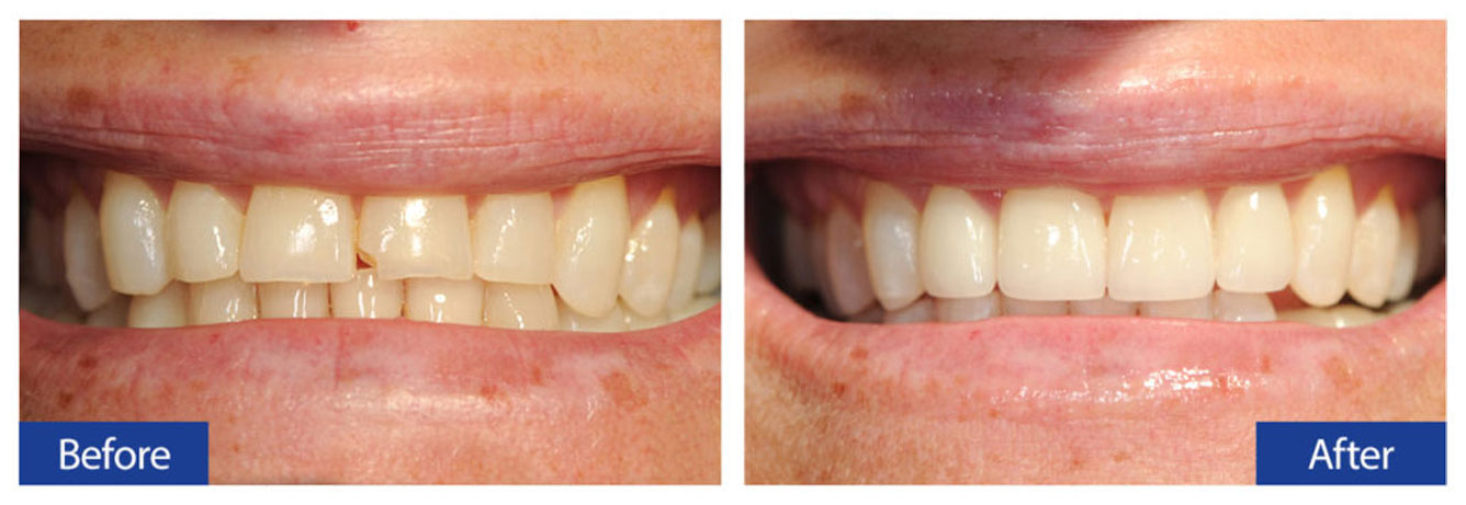 Before and After Teeth 11 Damon R. Johnson DDS Dental Excellence Edmond, OK