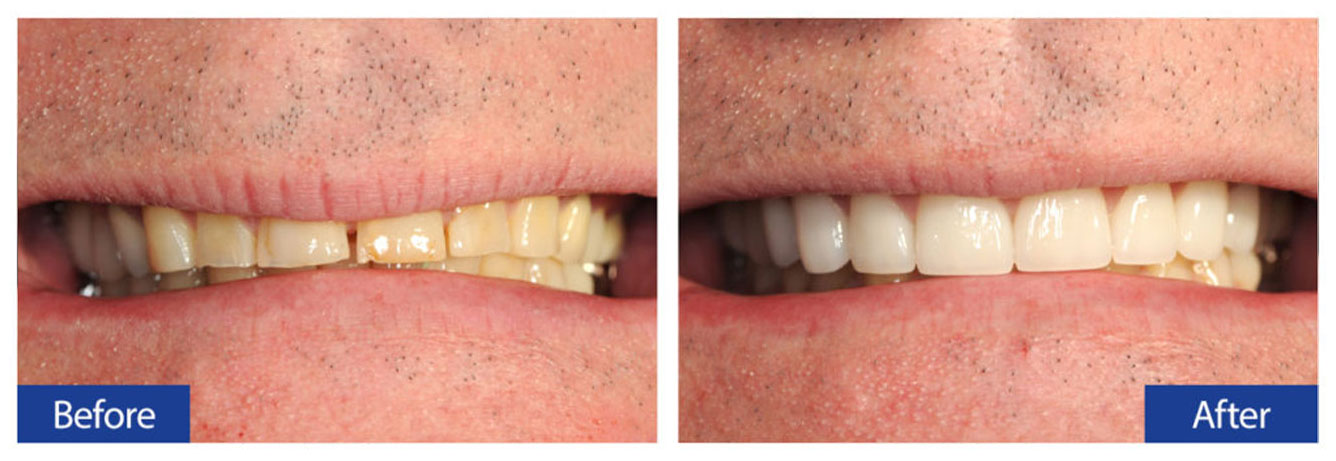 Before and After Teeth 10 Damon R. Johnson DDS Dental Excellence Edmond, OK