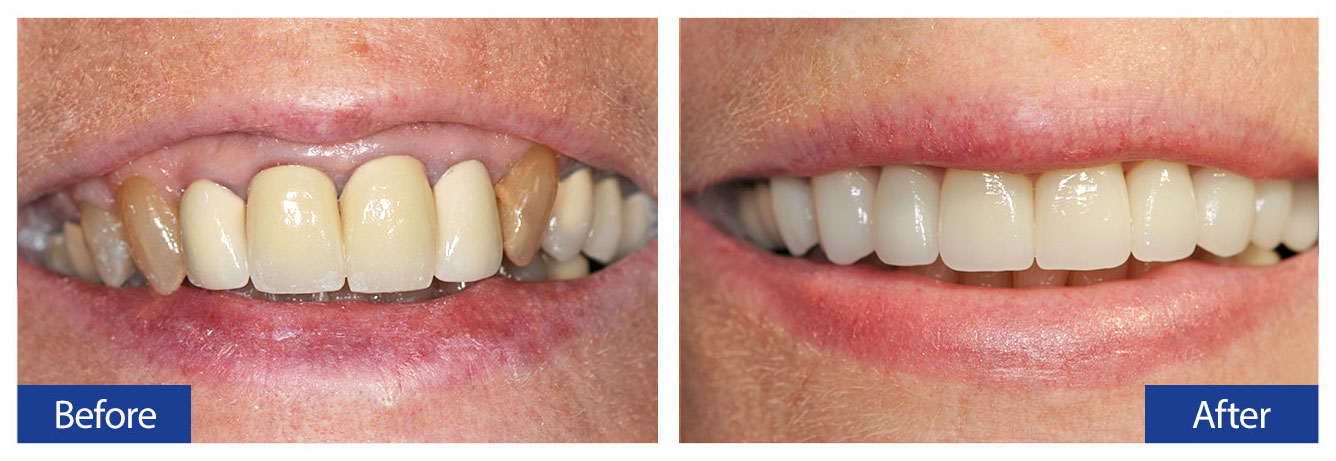 Before and After Teeth 9 Damon R. Johnson DDS Dental Excellence Edmond, OK