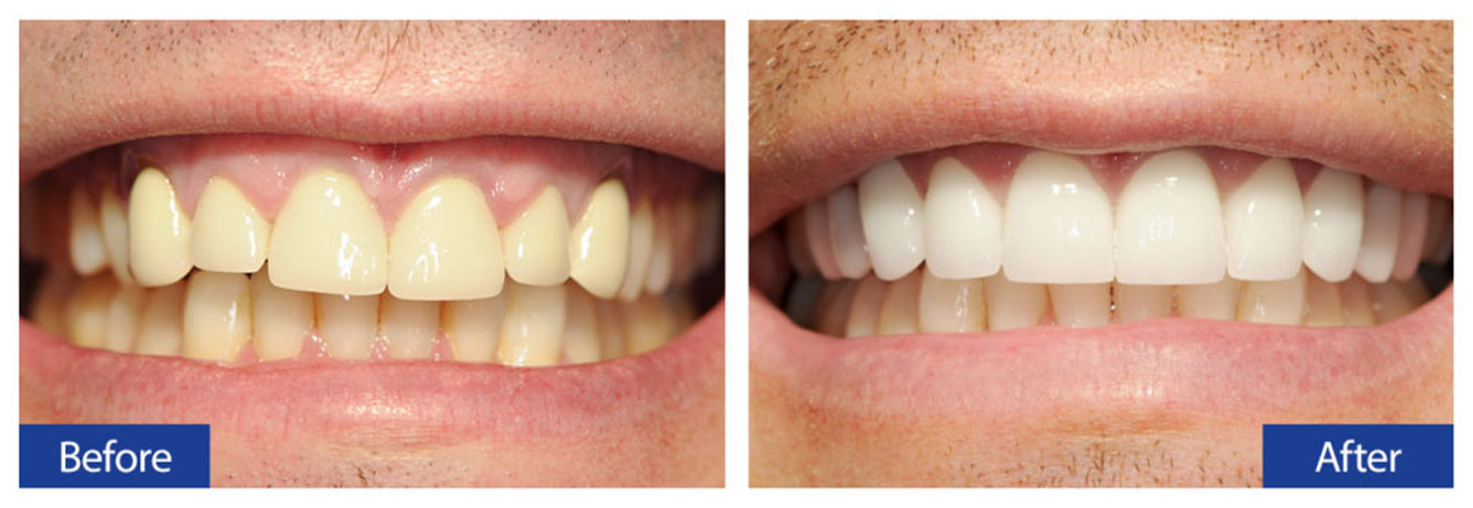 Before and After Teeth 9 Damon R. Johnson DDS Dental Excellence Edmond, OK