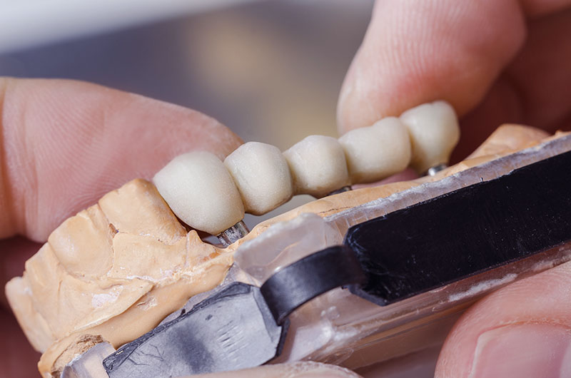 How Dental Bridges are Made
